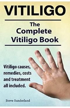 Vitiligo. Vitiligo causes, remedies, costs and treatment all included. The complete Vitiligo Book.
