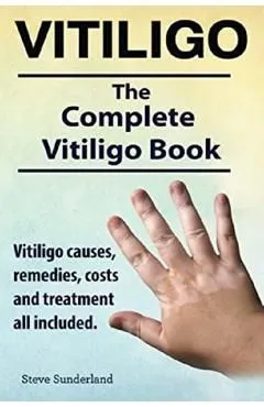 Vitiligo. Vitiligo causes, remedies, costs and treatment all included. The complete Vitiligo Book.