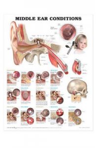 Middle Ear Conditions Anatomical Chart