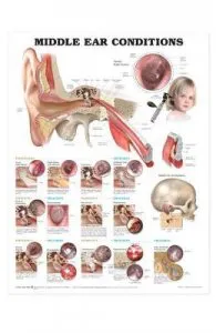 Middle Ear Conditions Anatomical Chart