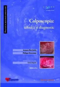 Colposcopia: tehnica si diagnostic